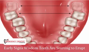 Early Signs Wisdom Teeth Are Starting to Erupt