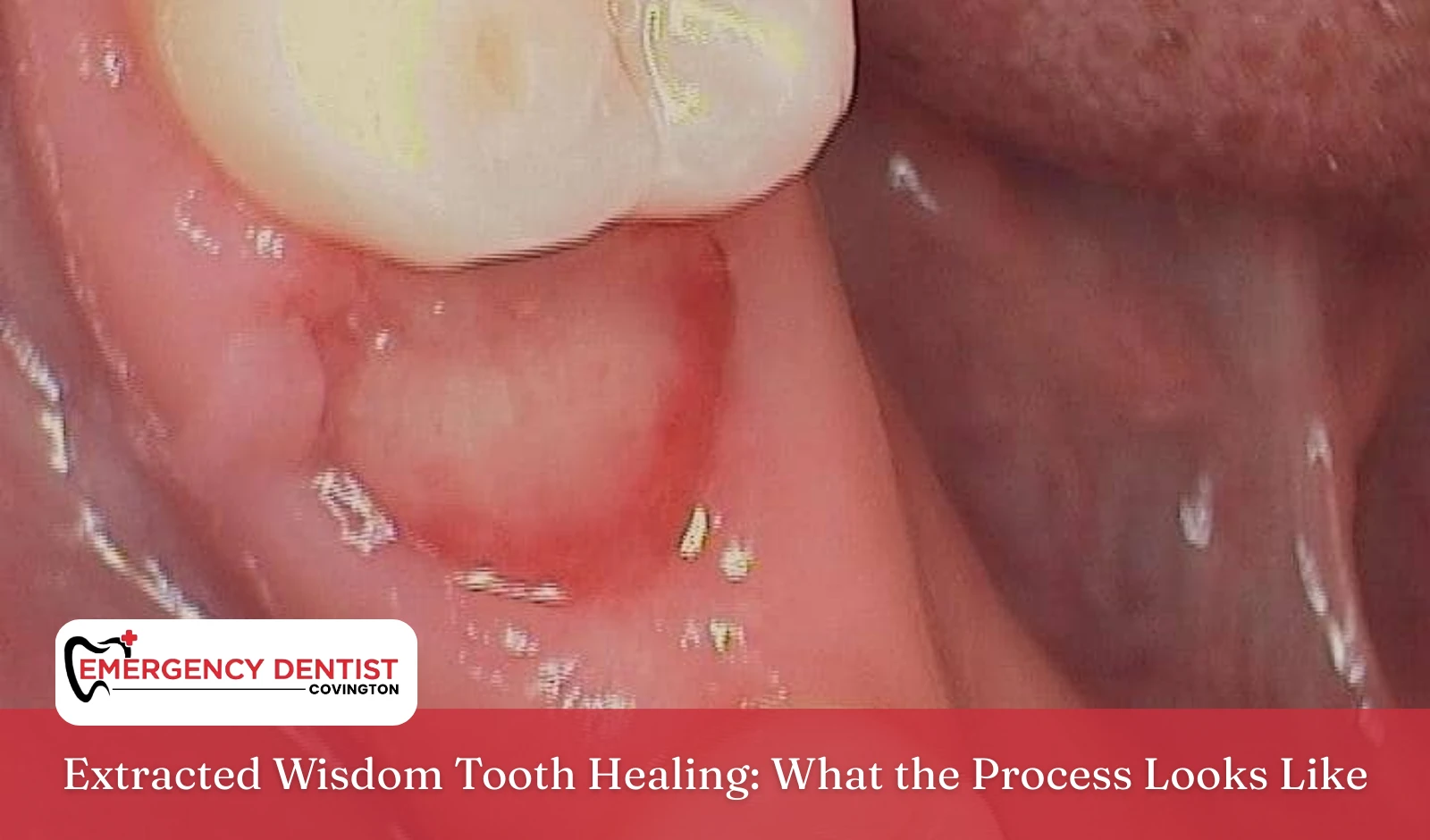 Extracted Wisdom Tooth Healing What the Process Looks Like
