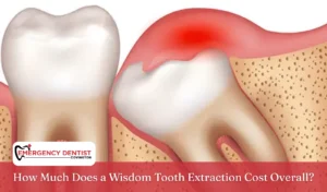 How Much Does a Wisdom Tooth Extraction Cost Overall