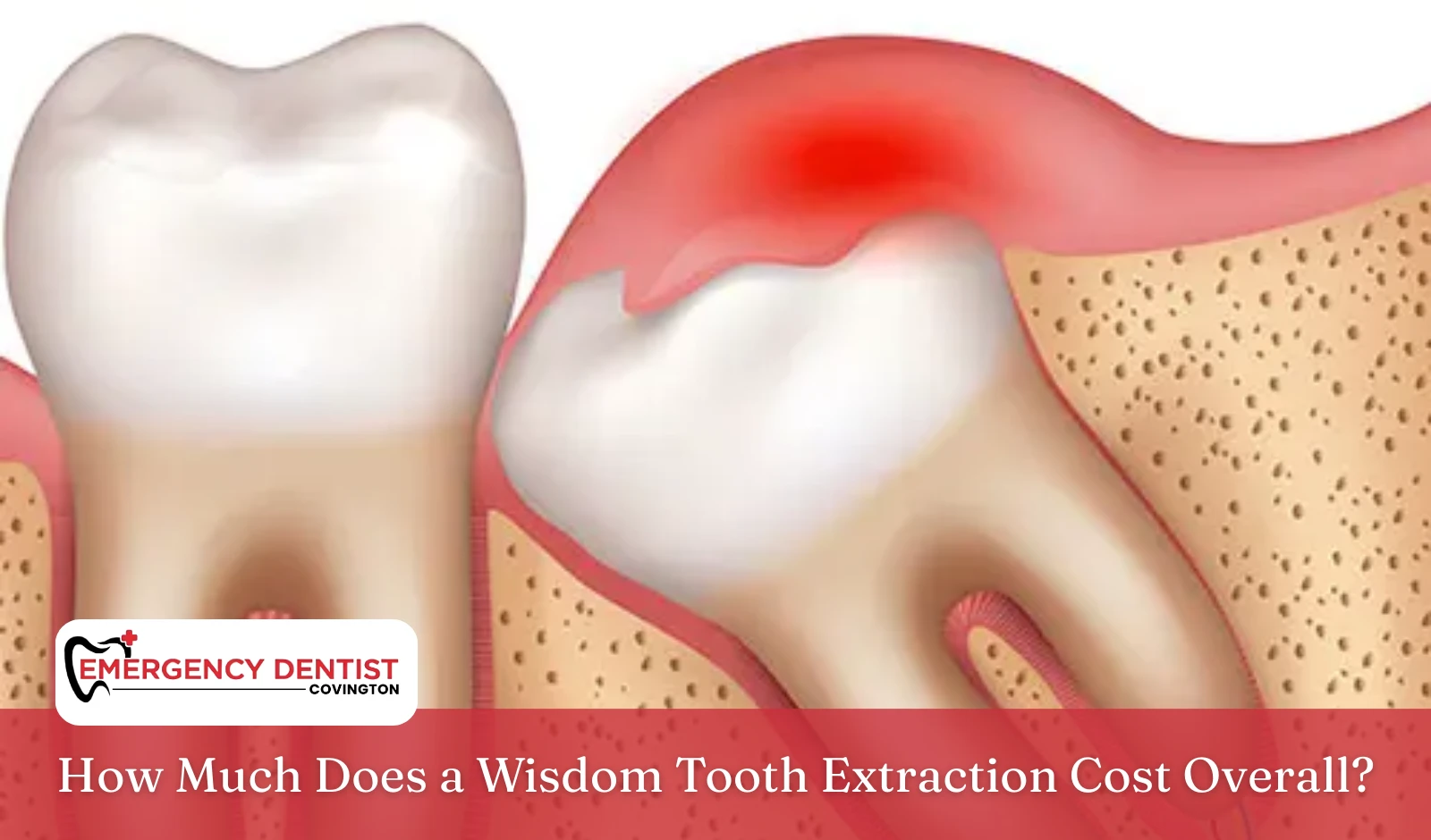 How Much Does a Wisdom Tooth Extraction Cost Overall