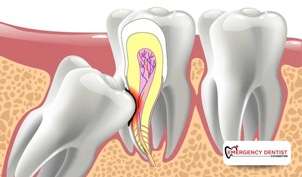 When Wisdom Teeth Removal May Be Discussed