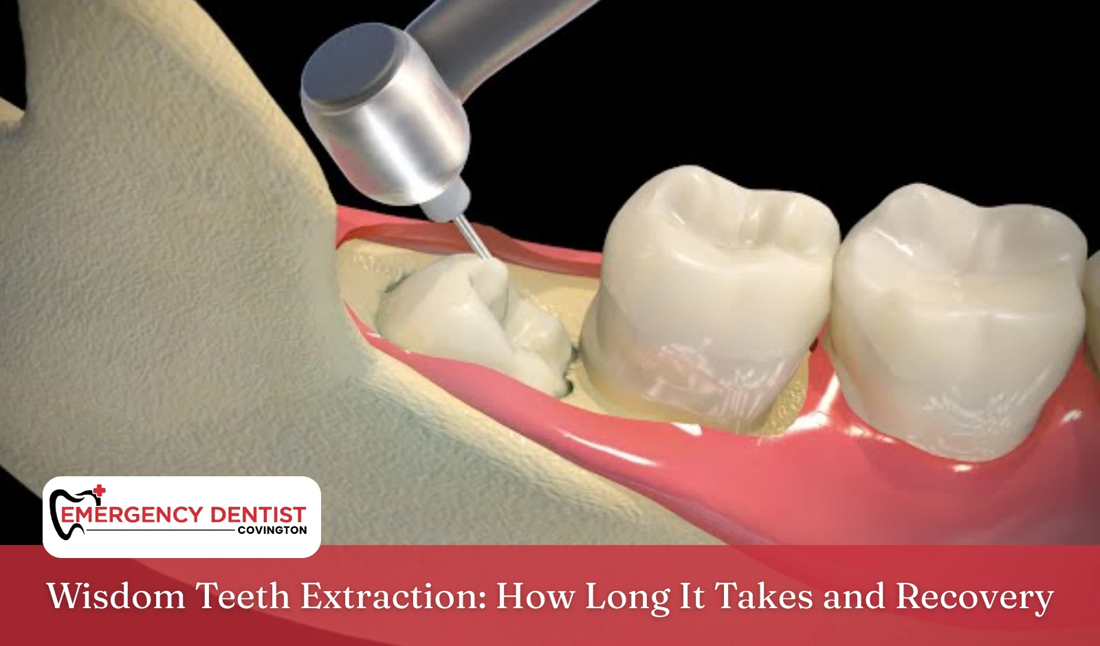 Wisdom Teeth Extraction How Long It Takes and Recovery