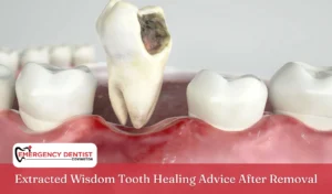 Extracted Wisdom Tooth Healing Advice After Removal