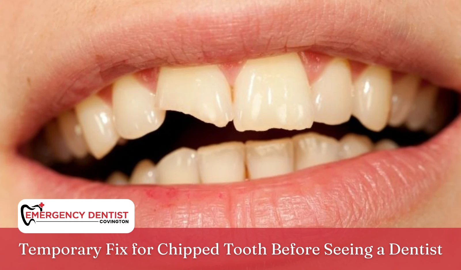 Temporary Fix for Chipped Tooth Before Seeing a Dentist