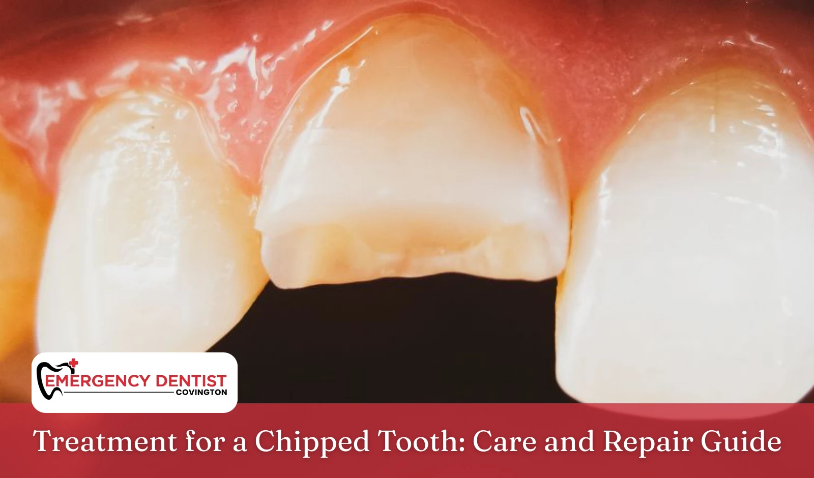 Treatment for a Chipped Tooth Care and Repair Guide