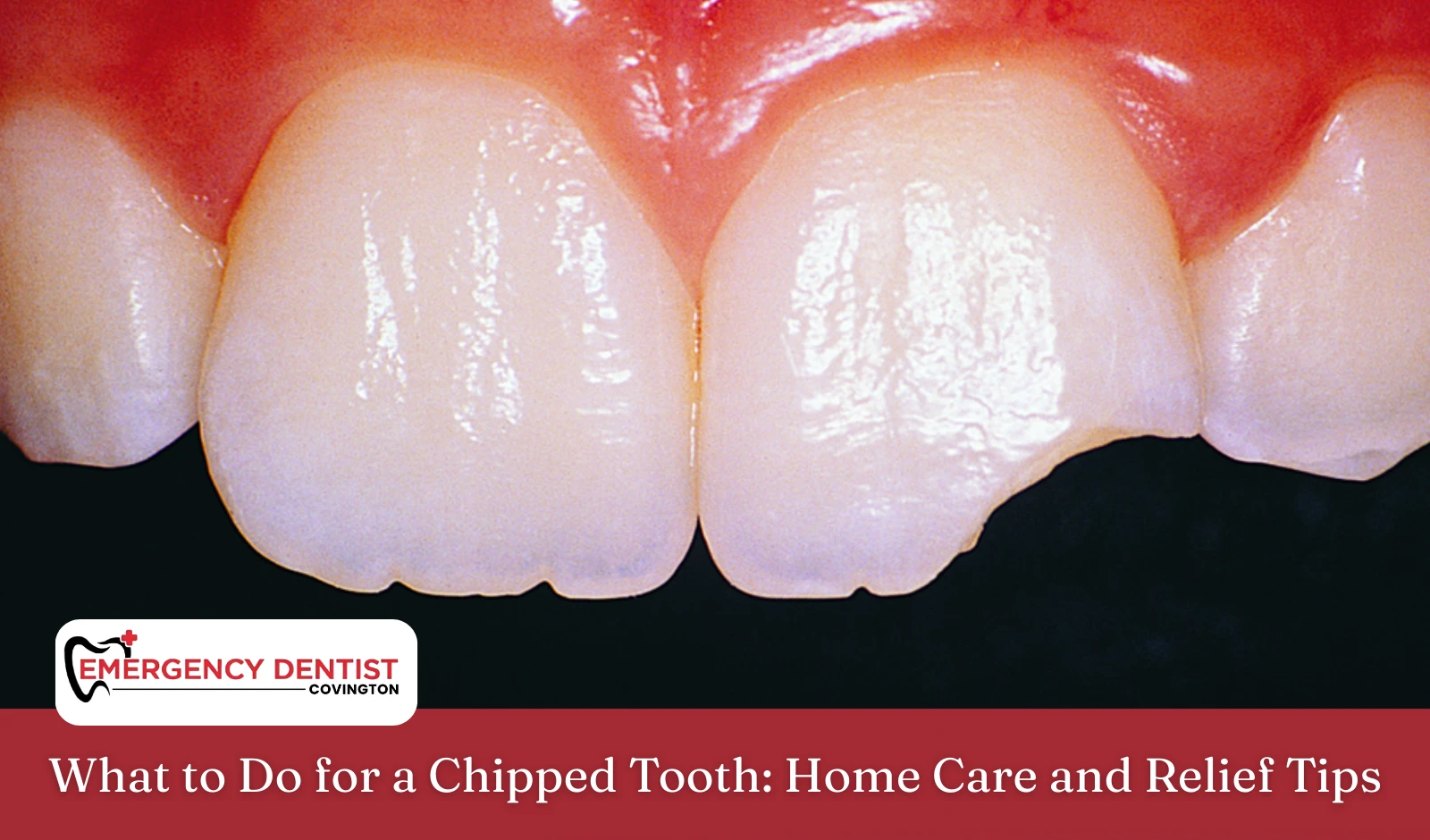 What to Do for a Chipped Tooth Home Care and Relief Tips