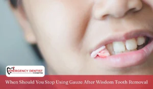 When Should You Stop Using Gauze After Wisdom Tooth Removal