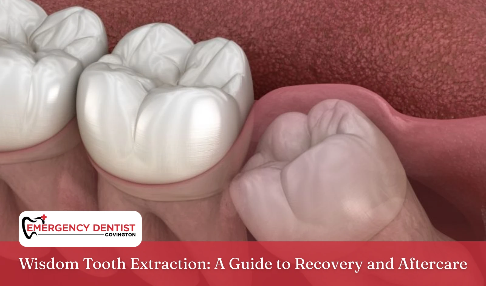 Wisdom Tooth Extraction A Guide to Recovery and Aftercare