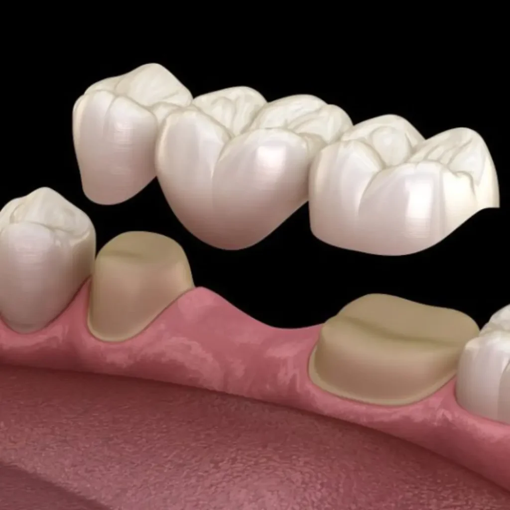 Accidental-damage-from-injury-or-biting-down-Covington-GA