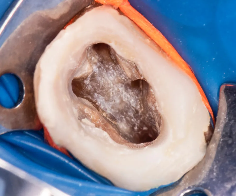 Cleaning-the-Root-Canal-Covington-GA