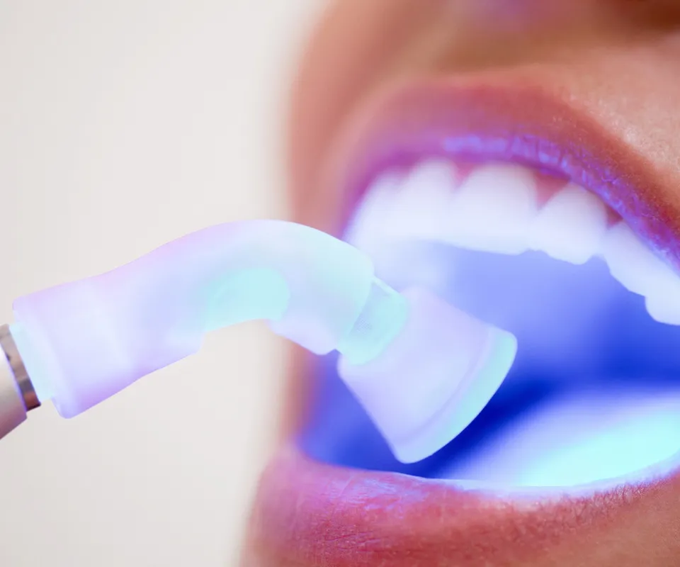 Dental-Bonding-or-Filling-Covington-GA