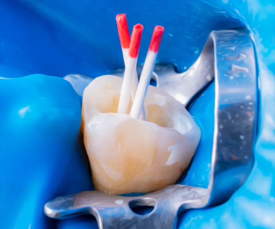 Filling-the-Root-Covington-GA