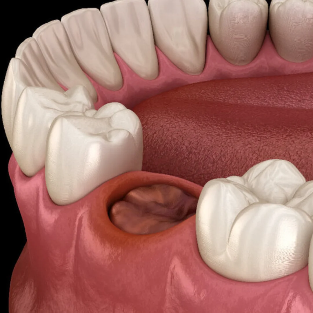 Symptoms-of-Dry-Socket-Covington-GA