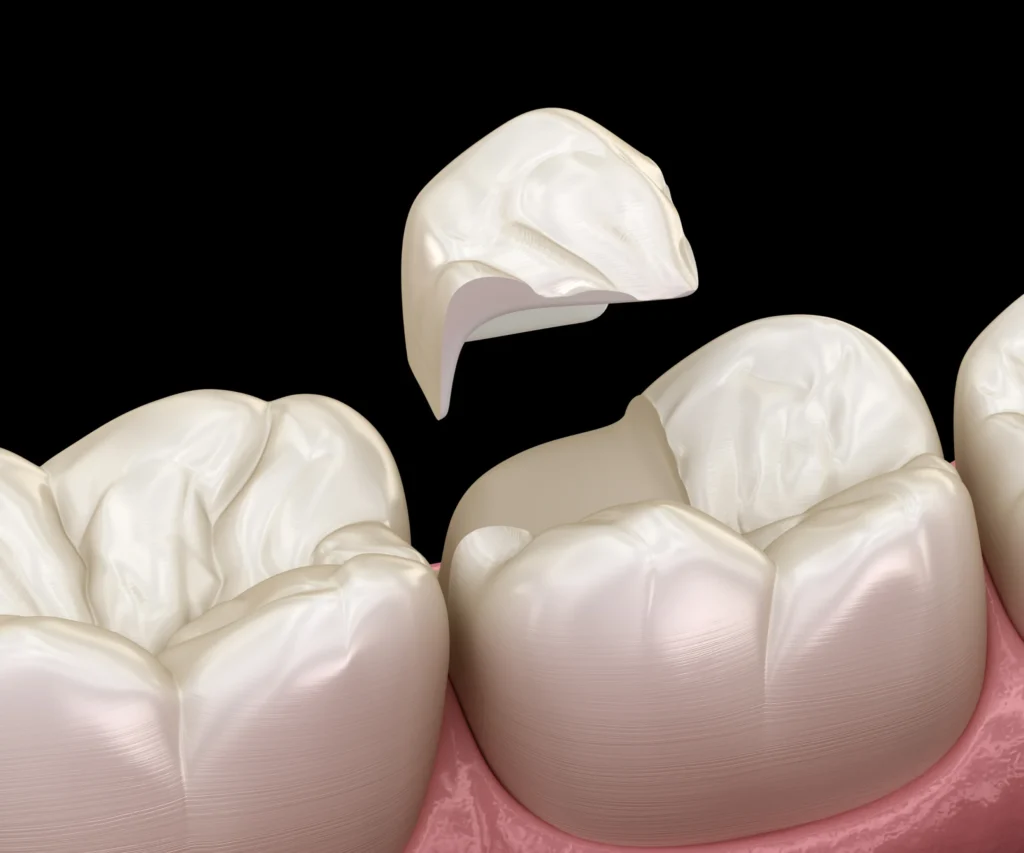 What-Causes-a-Cracked-Tooth-Covington-GA