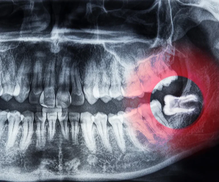 Wisdom-Tooth-Infection-Emergencies-Covington-GA