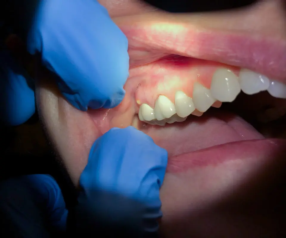Abscesses-or-Infections-Covington-GA
