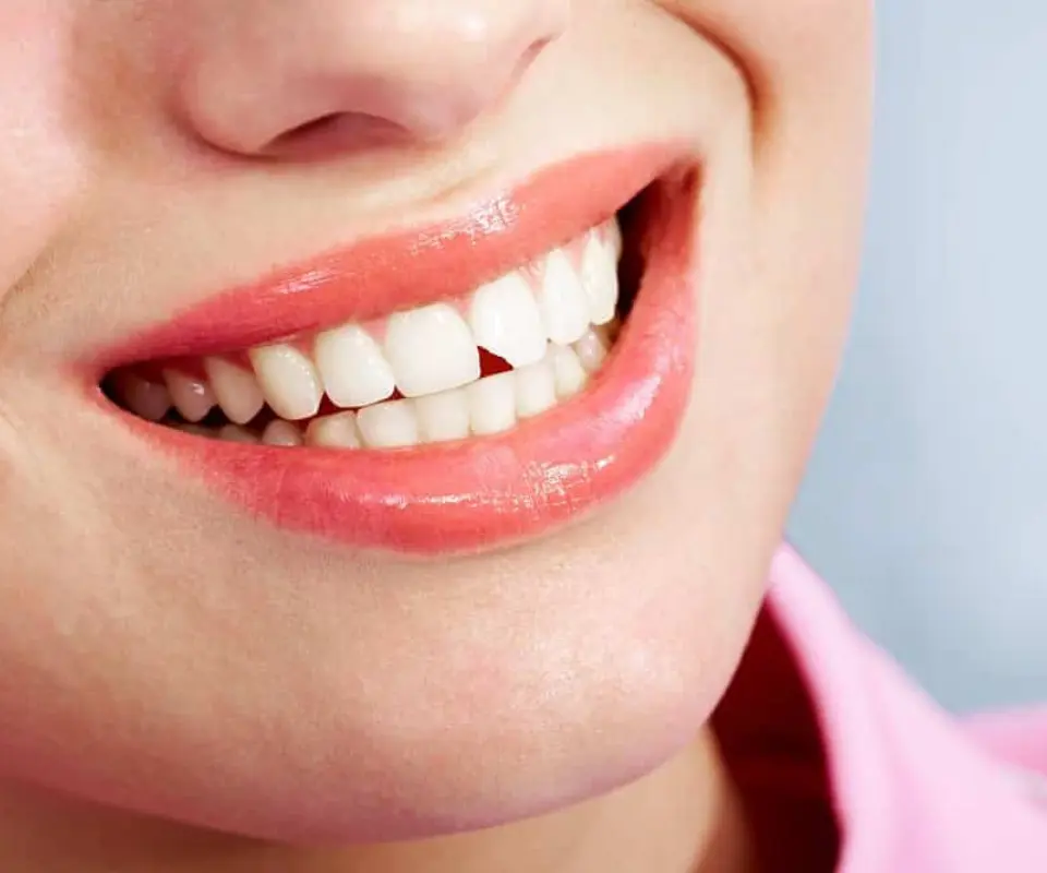 Chipped-Teeth-Covington-GA