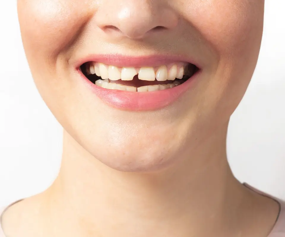 Cracked-or-Broken-Teeth-Covington-GA
