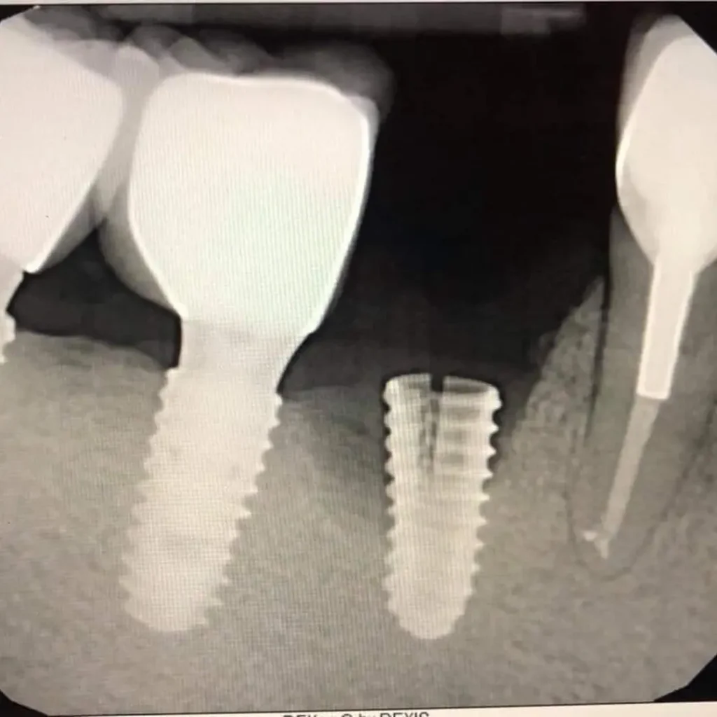 Cracked-or-fractured-implants-Covington-GA