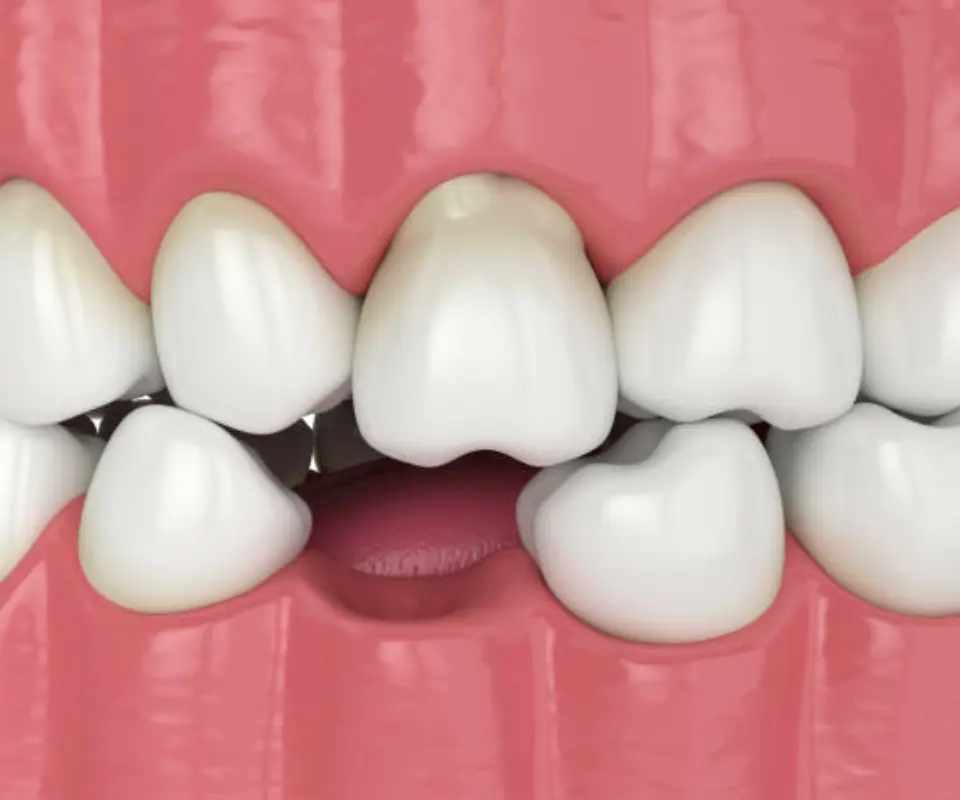Dislocated-Teeth-Covington-GA