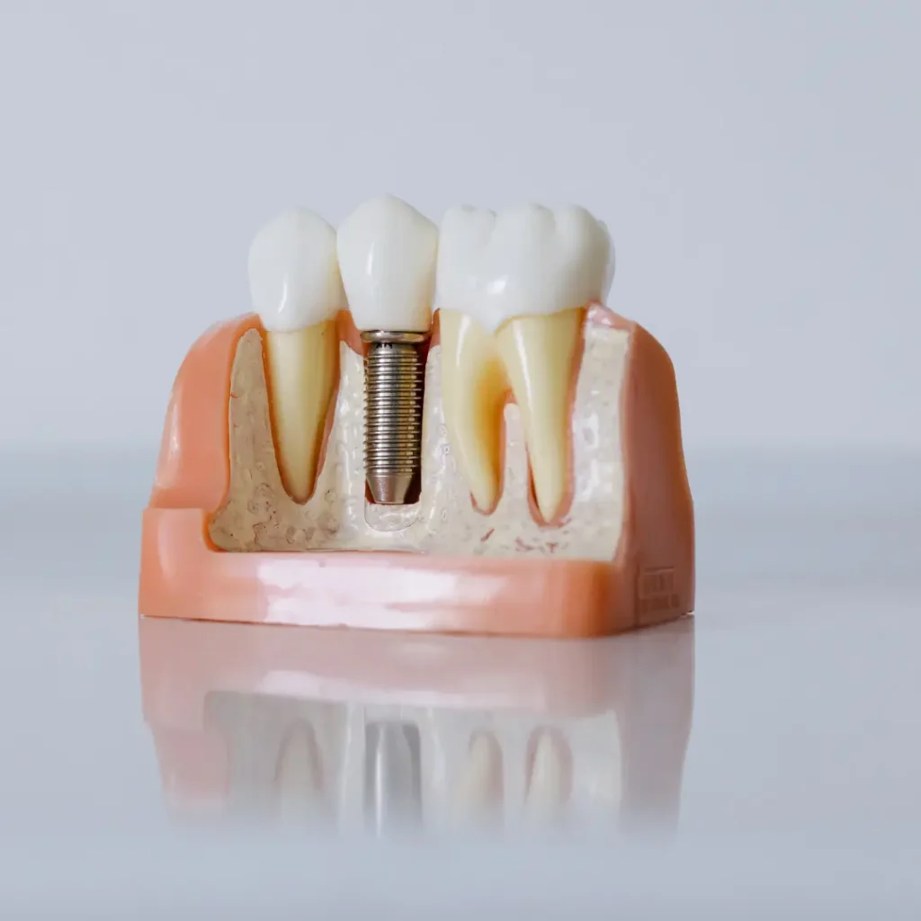Emergency-Dental-Implant-Covington-GA