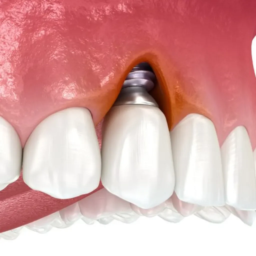 Infection-or-pain-around-an-implant-Covington-GA