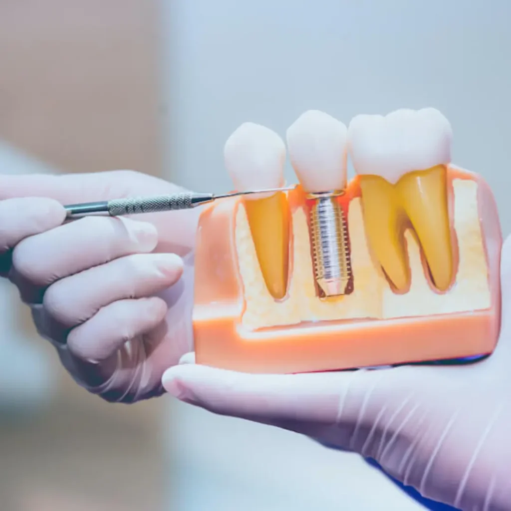 Loose-or-shifting-dental-implants-Covington-GA