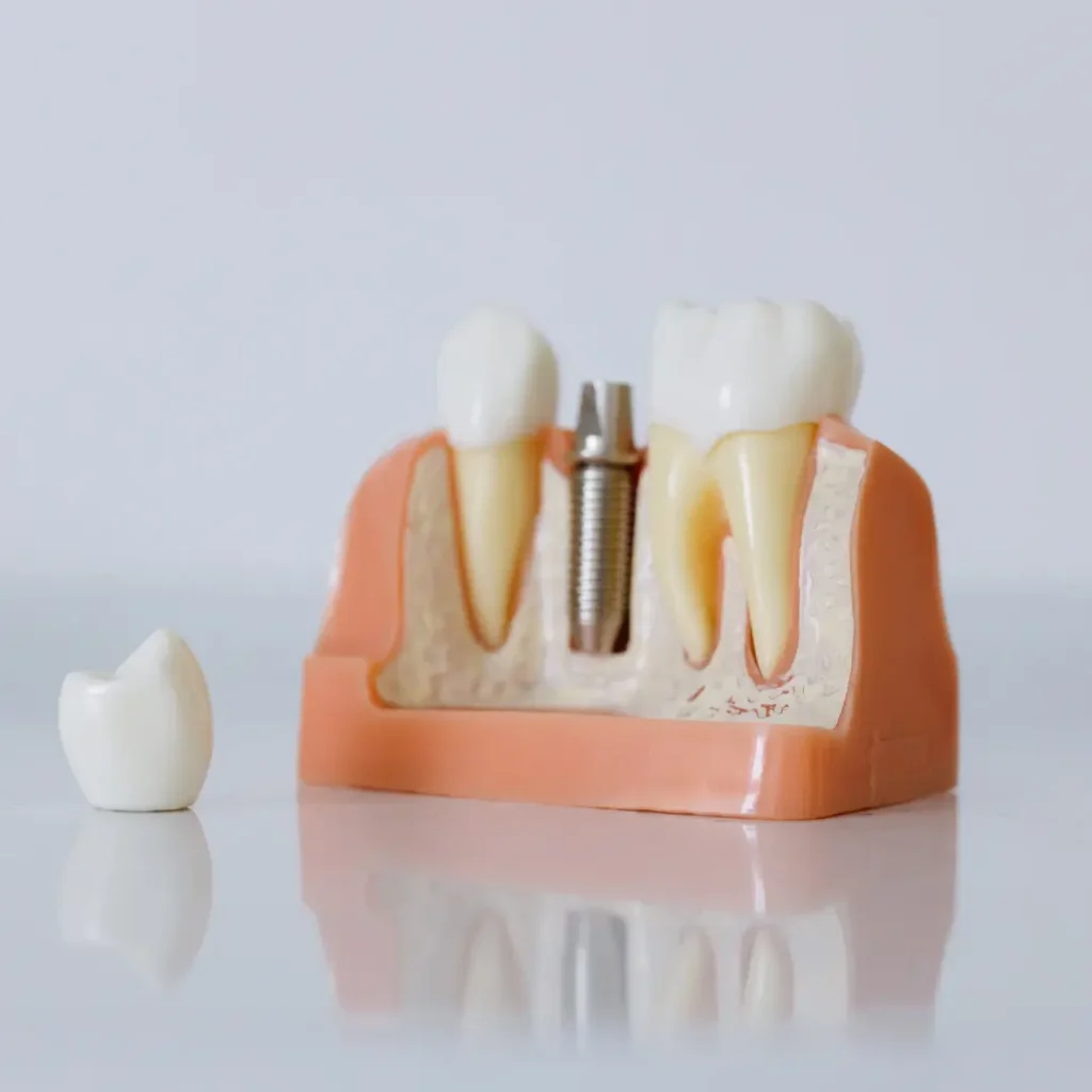 The-implant-crown-fell-off-or-broke-Covington-GA