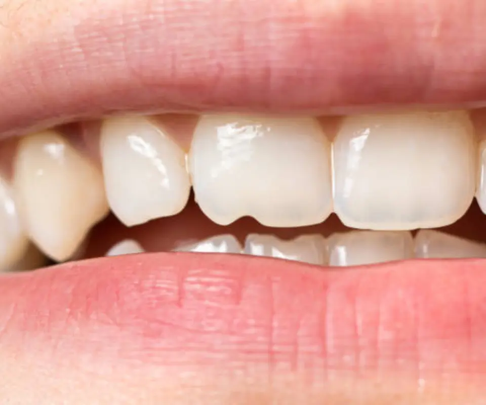 Tooth-Fractures-Covington-GA