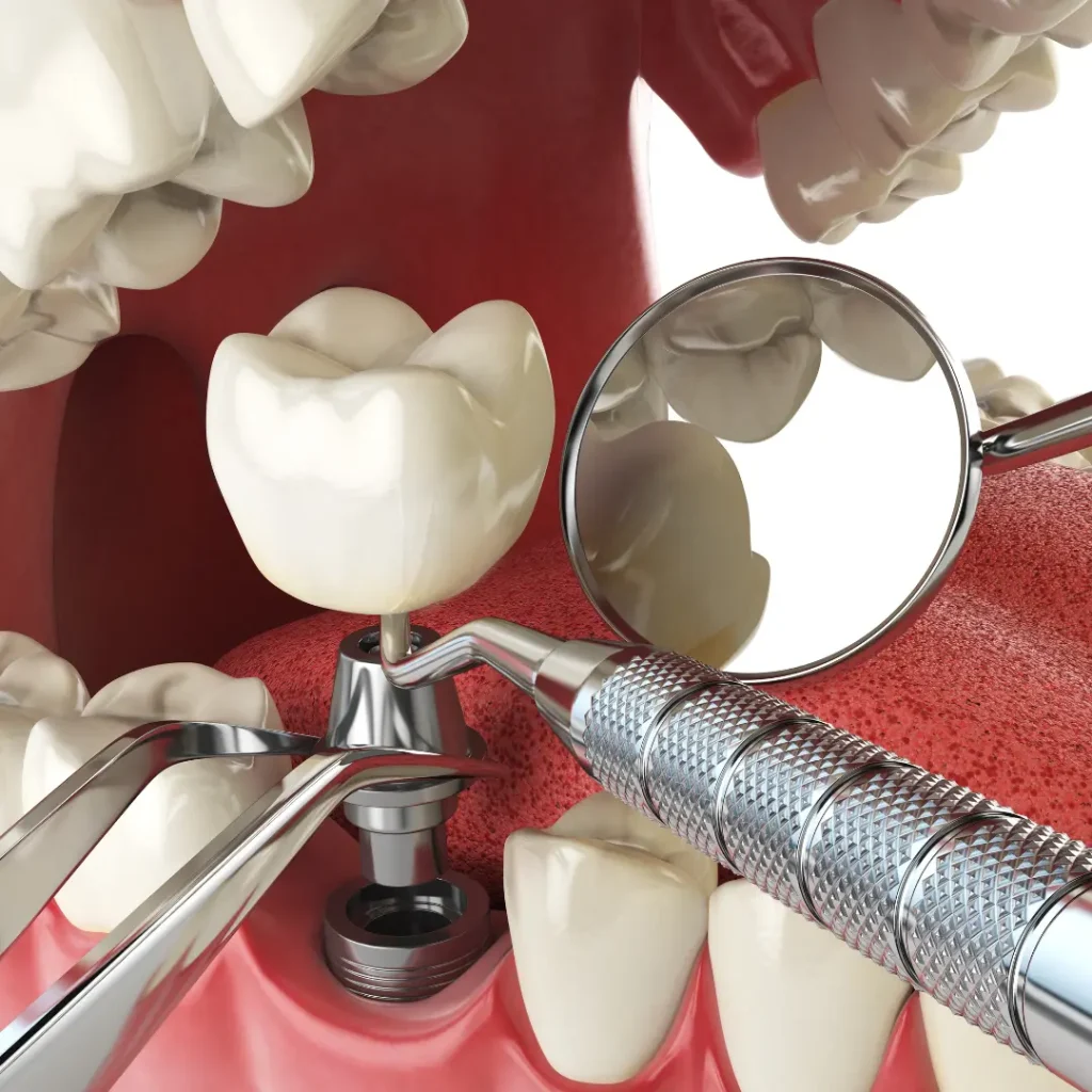 Trauma-related-tooth-loss-needs-immediate-implants-Covington-GA