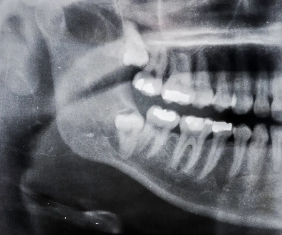 Wisdom-Tooth-Complications-Covington-GA