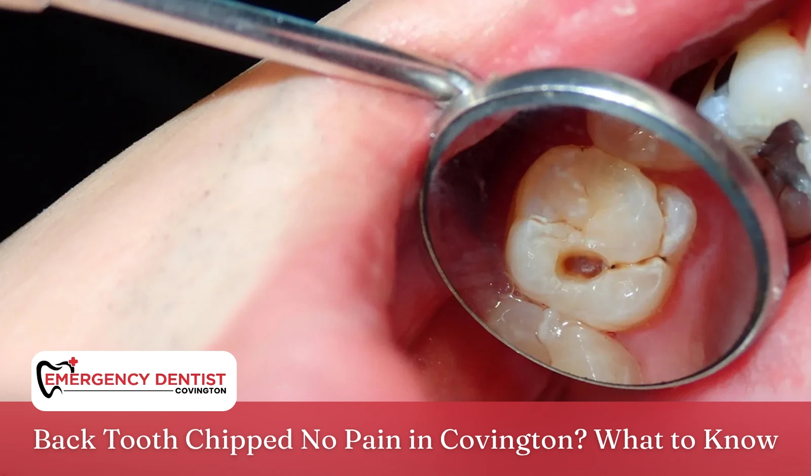 Back Tooth Chipped No Pain in Covington What to Know